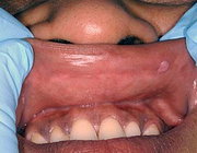 Focale epitheliale hyperplasie van het mondslijmvlies