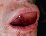 Hematoom in de mondbodem na een implantaatbehandeling