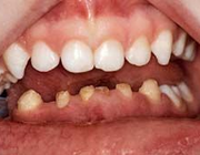 Een spookachtige afwijking: regionale odontodysplasie