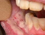 Een toxische reactie van de mondmucosa op orale bisfosfonaten