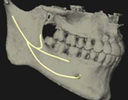 Canalis mandibulae bifidus en trifidus
