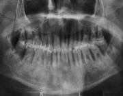 Ernstige parodontitis als oorzaak voor onbegrepen koorts