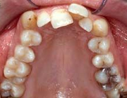 Orthodontisch-chirurgische behandeling maakt einde aan temporomandibulaire disfunctieklachten