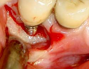 Complicaties bij patiënten met orale implantaten