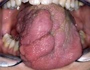 Een gingivahyperplasie op basis van neurofibromatose