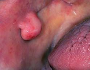 Verwijzing van patiënten met niet-odontogene mondaandoeningen naar een mond-, kaak- en aangezichtschirurg