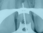 Endostart bij pijnlijke parodontitis apicalis