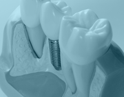 Implantaatoverleving bij een voorgeschiedenis van parodontitis