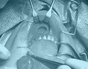 Staken ontstollingsmedicatie niet noodzakelijk bij tandheelkundige behandelingen