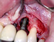 Peri-implantitis in de algemene kaakchirurgische praktijk