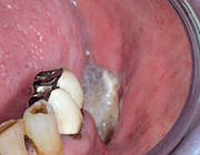 Osteoradionecrose van de mandibula, vermoedelijk veroorzaakt door een frameprothese