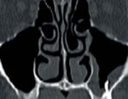 Odontogene sinusitis maxillaris op basis van doorgeperst wortelkanaalvulmateriaal