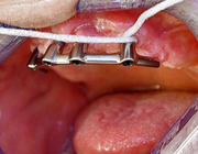 Implantaatgedragen kronen en bruggen bij parodontaal gecompromitteerde patiënten