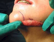 Toepassing van alloplastische materialen bij augmentaties in de cosmetische aangezichtschirurgie