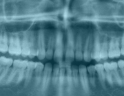 Kosten van röntgenopnamen van derde molaren