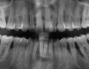 Langetermijnresultaten van parodontale behandeling