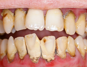 Invloed van parodontitis en obesitas op COVID-19