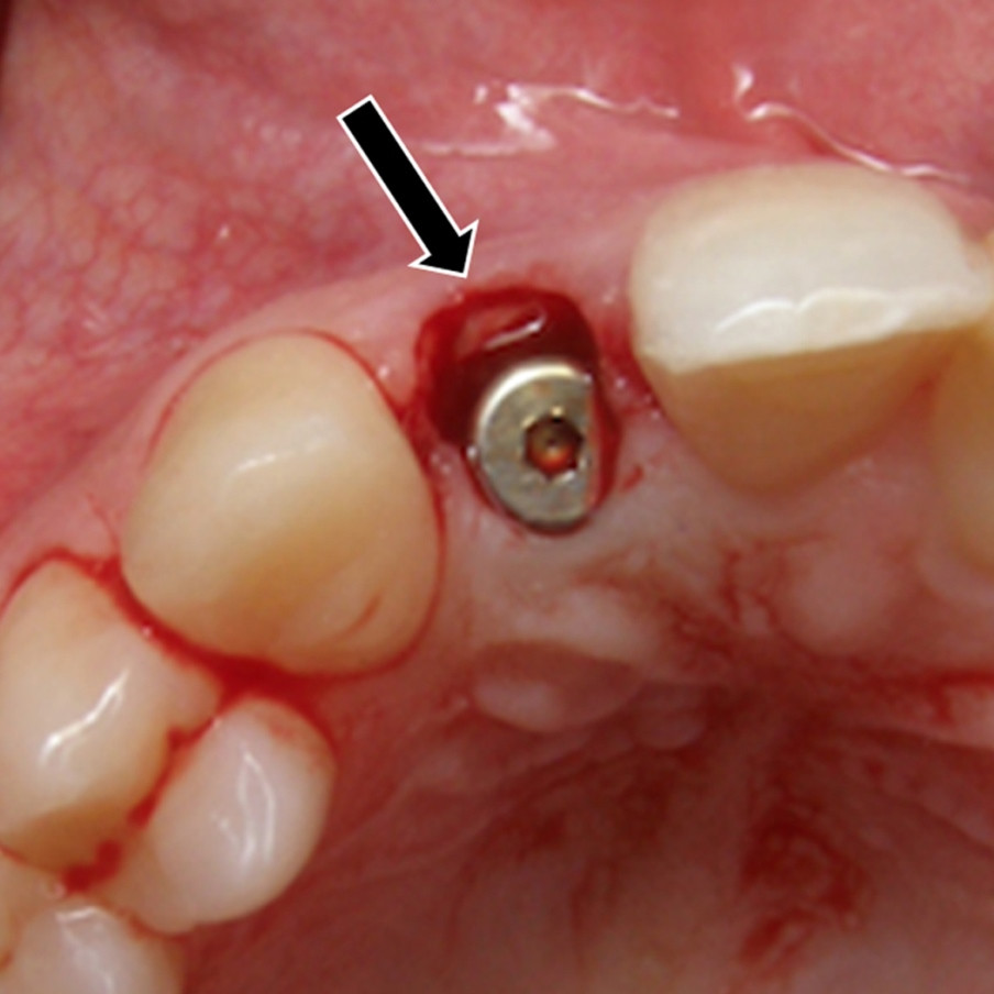 Afb. 2. Occlusaal aanzicht. Het implantaat in de regio van gebitselement 12 is meer naar palatinaal geplaatst. De ruimte tussen de buccale gingiva en het implantaat wordt opgevuld door het buccale deel van de oorspronkelijke radix (zie pijl).