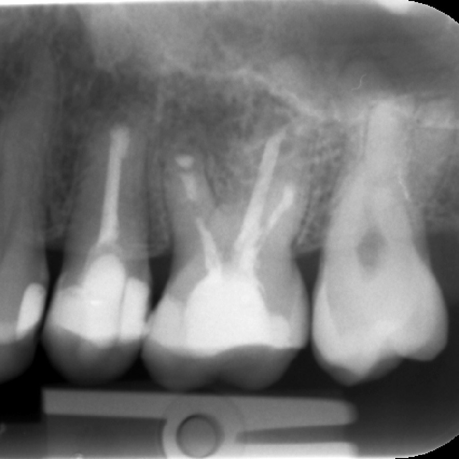 Afb. 1. Röntgenopname van het tweede kwadrant, waarop te zien is dat gebitselementen 25 en 26 endodontisch zijn behandeld en voorzien zijn van een plastisch restauratiemateriaal.