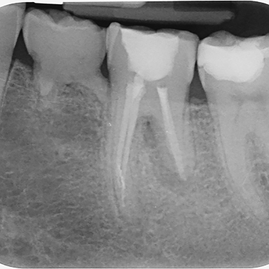 Afb. 2. Gebitselement 36 na de afgeronde endodontische behandeling.