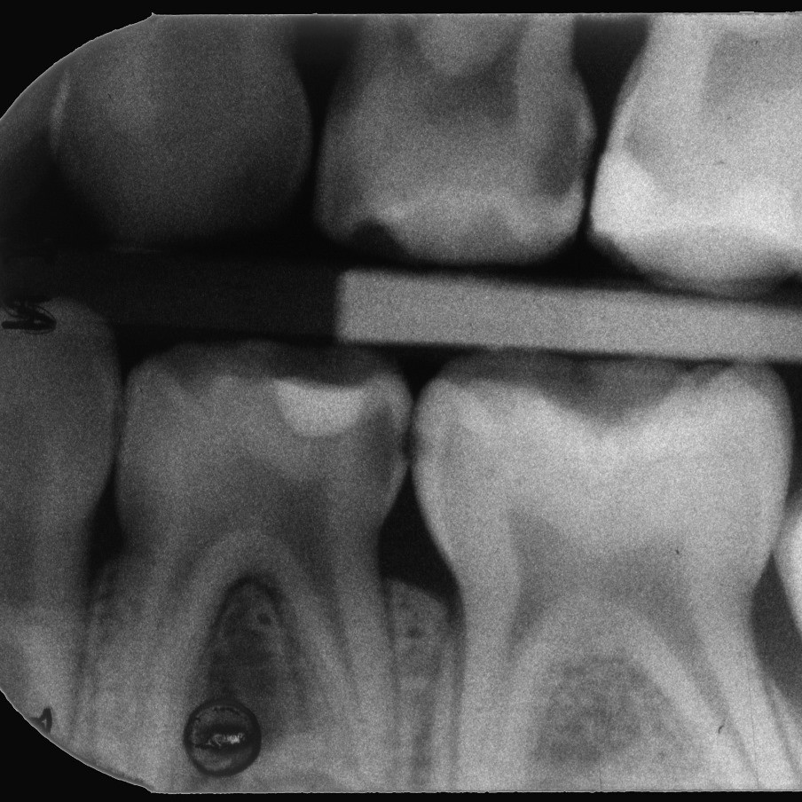 Afb. 1.Linker bitewing-opname van een 6-jarige met duidelijk waarneembare dentinecariës.