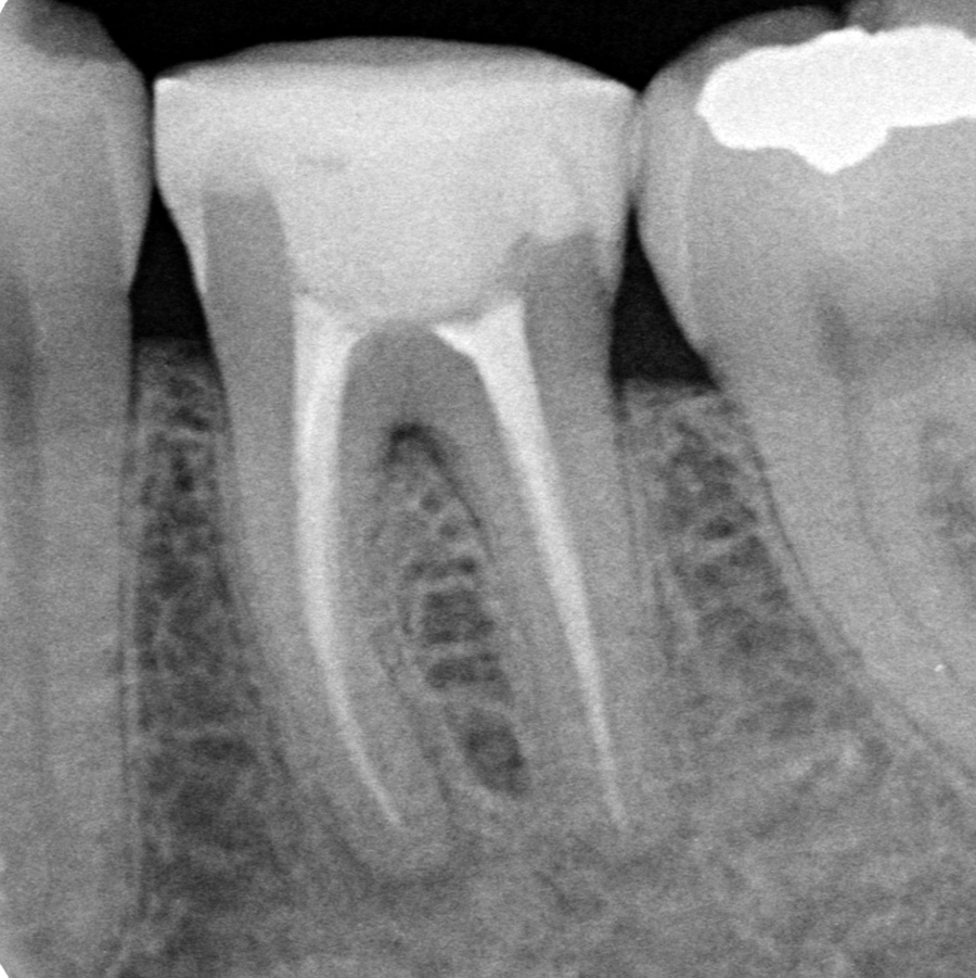 Afb. 1b. Radiolucenties 2 jaar na endodontische behandeling.