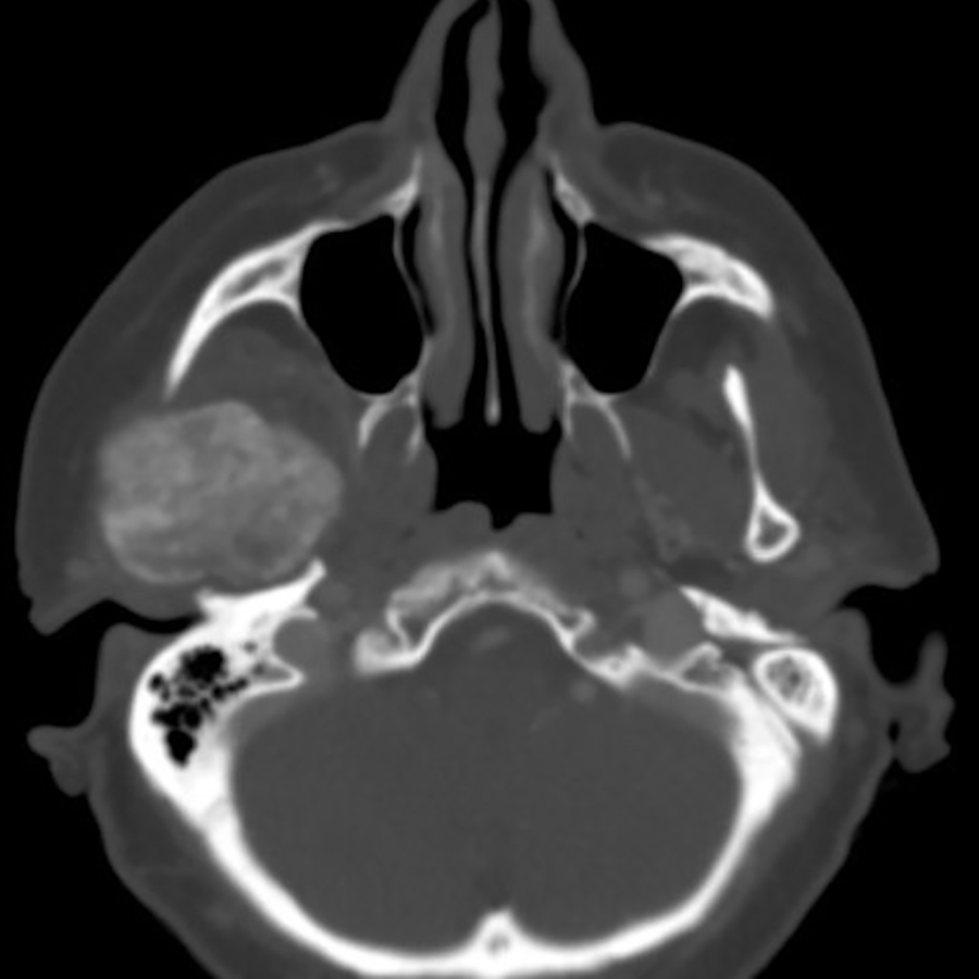 Afb. 3a. MRI-scan van jicht ter hoogte van het kaakgewricht.