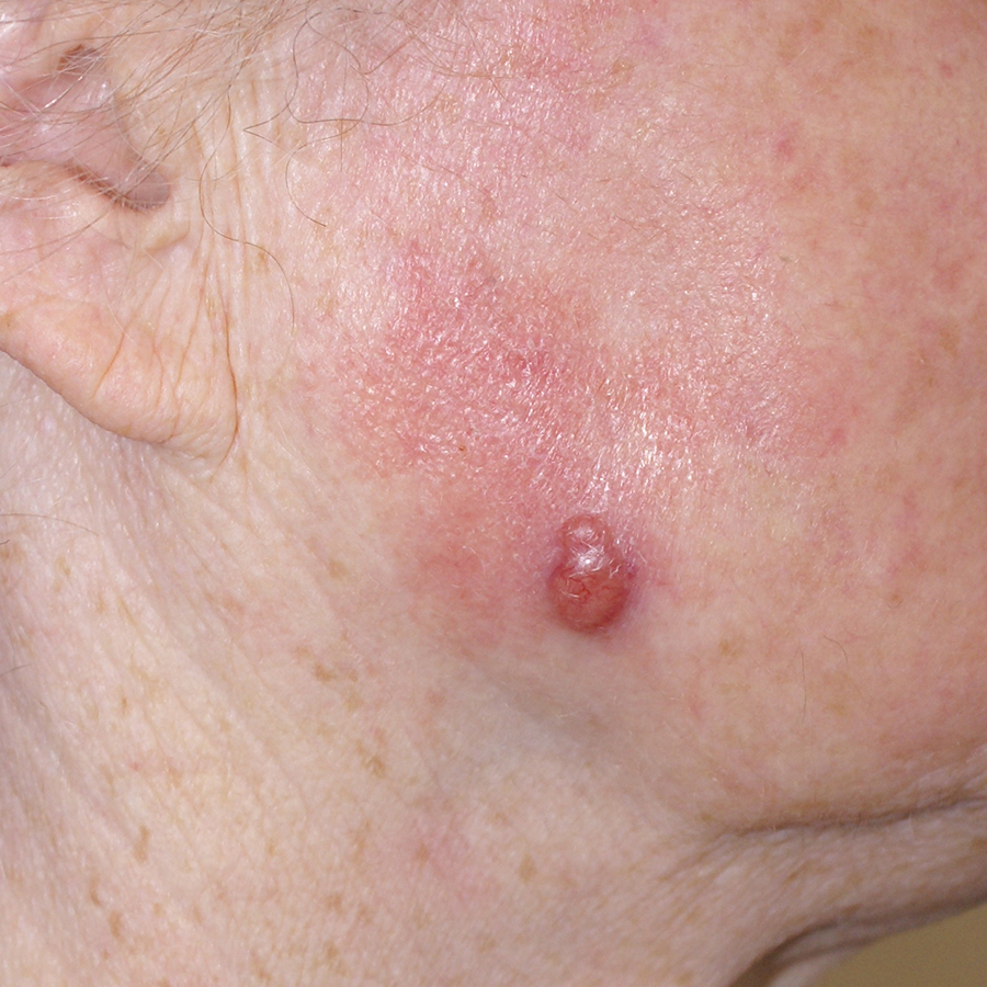 Afb. 1c. Een amelanotisch melanoom op de wang