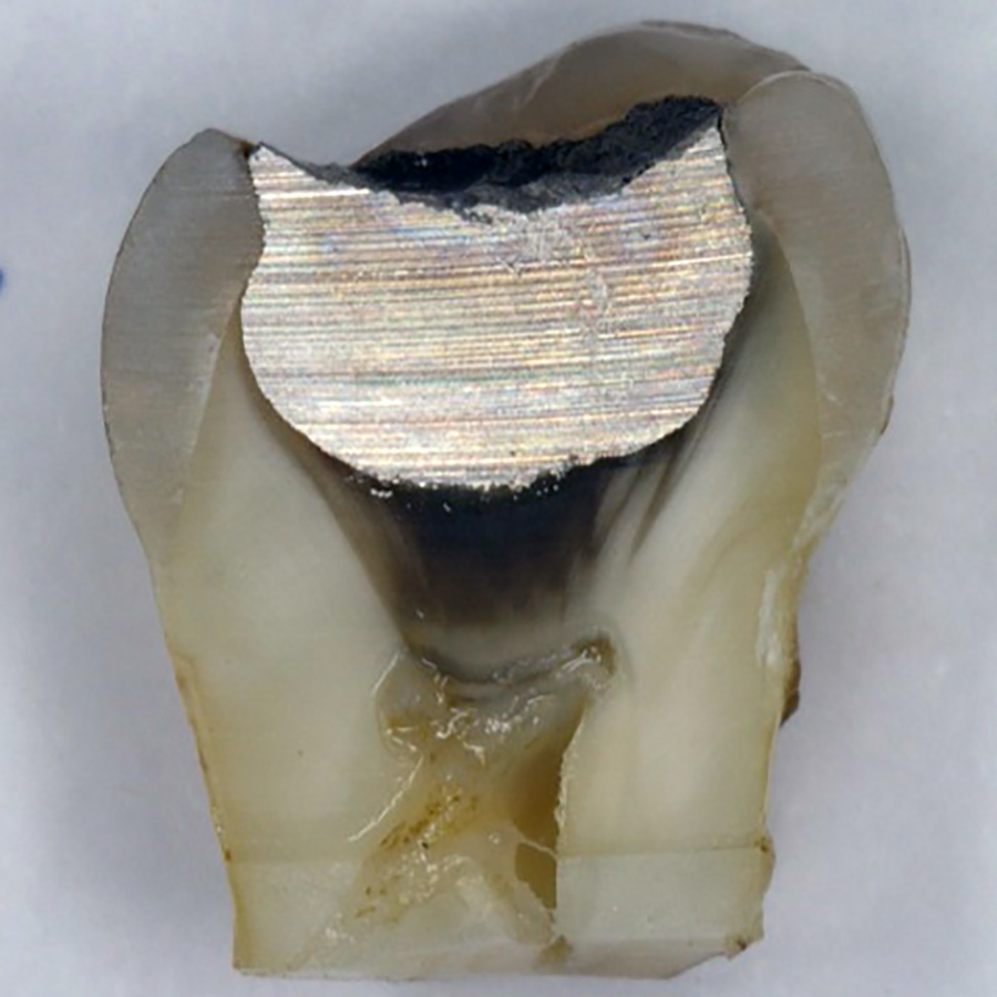 Een molaar met amalgaamrestauratie en donker verkleurd dentine.