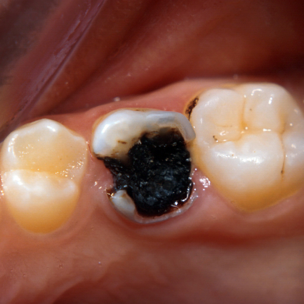 Afb. 2. Grote open dentinecaviteit in tijdelijk gebit