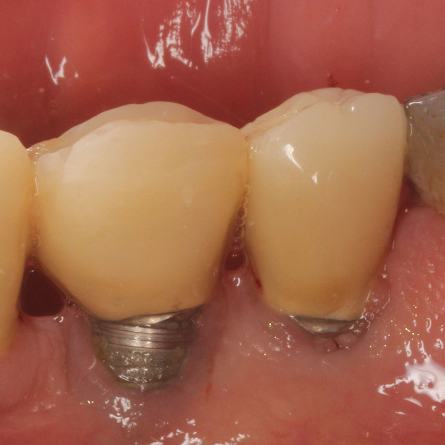 Afb. 2. Ruwe deel implantaat is in de mond blootgesteld.