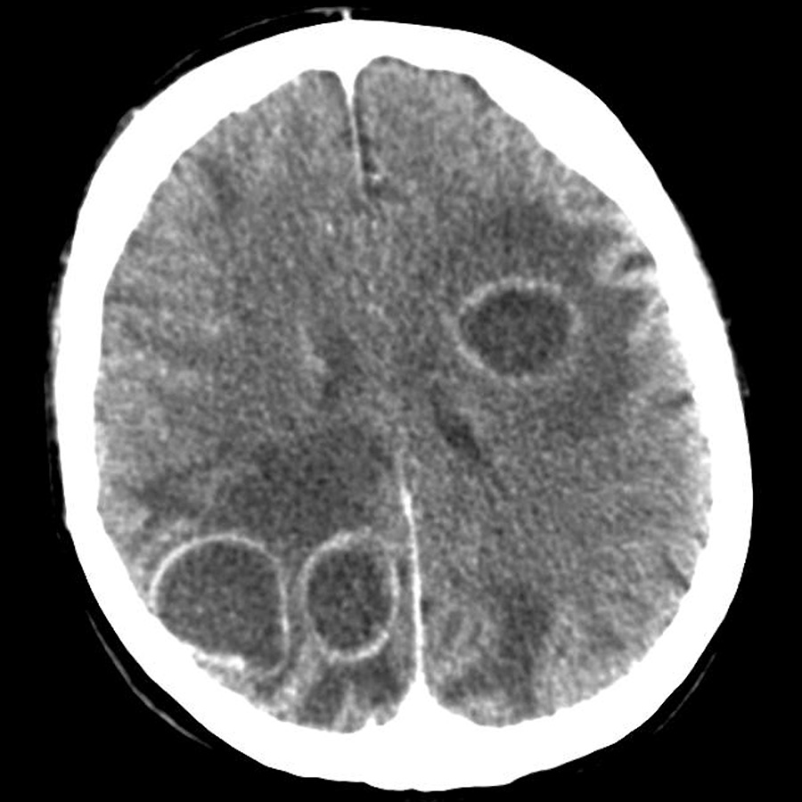 Afb. 3. CT-scan van brein tootn meerdere laesies.