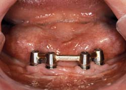 Afb. 8. Vier implantaten en staaf-hulsmesostructuur in het interforaminale deel van de mandibula om de laterale delen van de atrofische processus alveolaris enigszins te ontlasten.