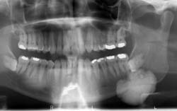 Afb. 1. Panoramische röntgenopname bij de angulus mandibulae een circumscripte, homogene densiteit met een gelobd aspect.