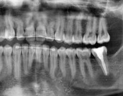Afb. 2. Panoramische röntgenopname na endodontische behandeling van gebitselement 37.