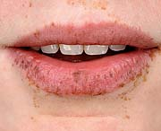 Afb.1. Typische pigmentaties op en rond de lippen van een patiënt met het syndroom van Peutz-Jeghers.