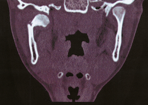 Afb. 3. Een coronale coupe van een computertomogram met een fractuur van het rechter collum mandibulae met dislocatie.