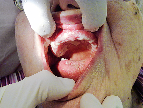 Afb. 1. Voedselresten op de tong en de orale mucosa