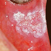Afb. 2. Candida geassocieerde leukoplakie in de linker mondhoek.
