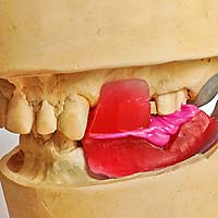Afb. 3. Registratieplaten op de gebitsmodellen van zowel de maxilla als de mandibula die zijn vervaardigd vanwege het ontbreken van voldoende occlusale contacten. De maxillomandibulaire relatie is geregistreerd met een spuitbaar registratiemedium.