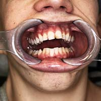 Afb. 2. De dentitie van patiënt is redelijk onderhouden.
