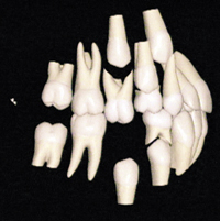 Afb. 8. a. Na prematuur verlies van een tweede mandibulaire melkmolaar kan de antagonist uitgroeien en daarmee migratie van de eerste blijvende mandibulaire molaar blokkeren.