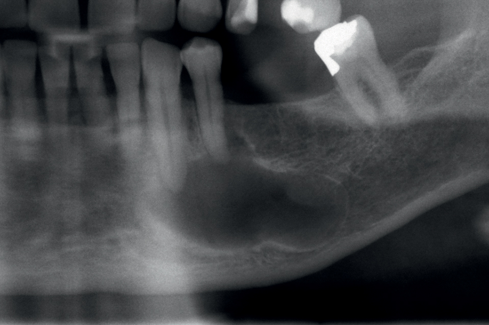Dentogene keratocyste