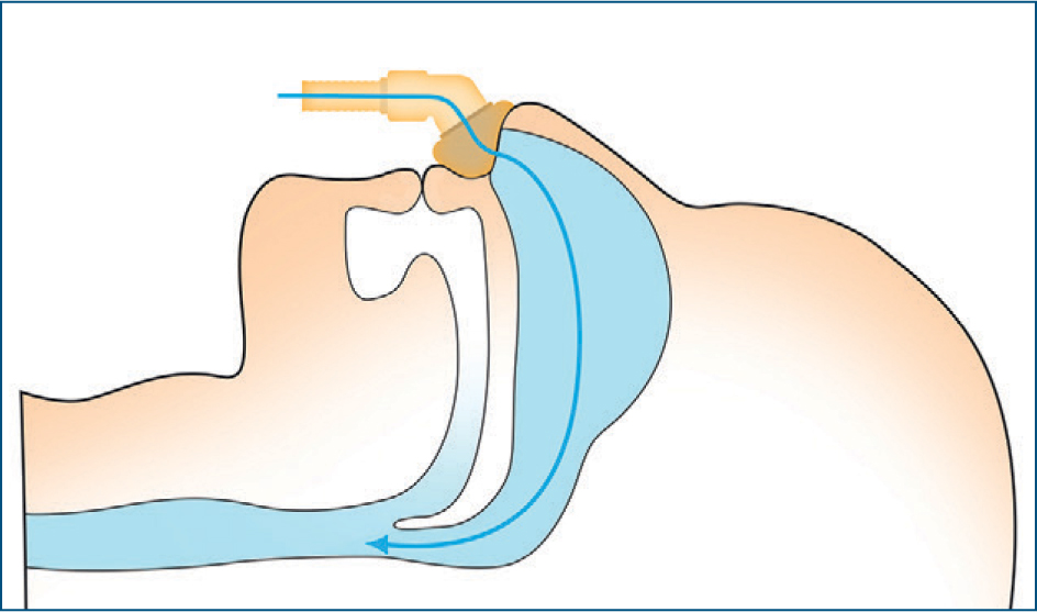 Verruiming luchtweg door CPAP-behandeling.