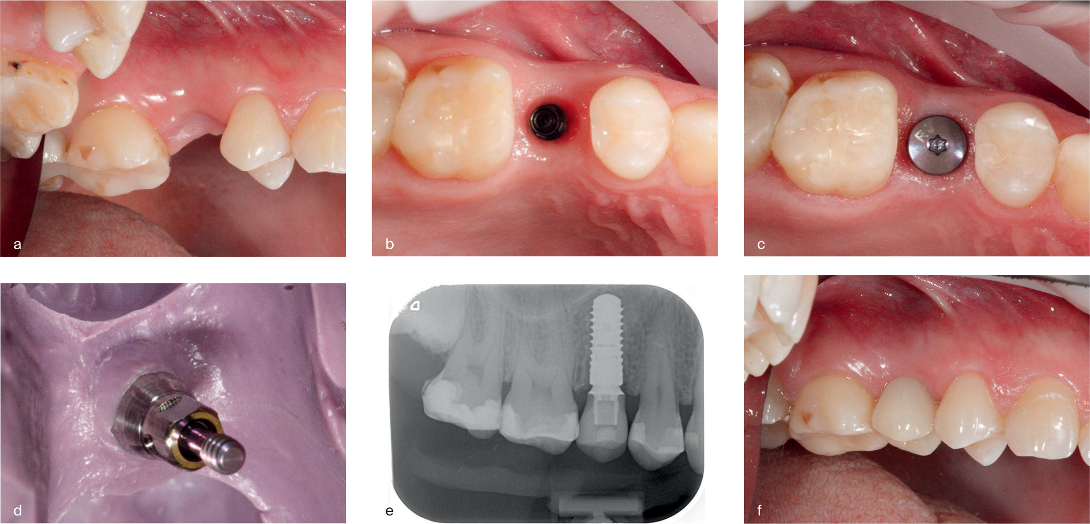 Behandeling met een Straumann™ titanium bone level implantaat