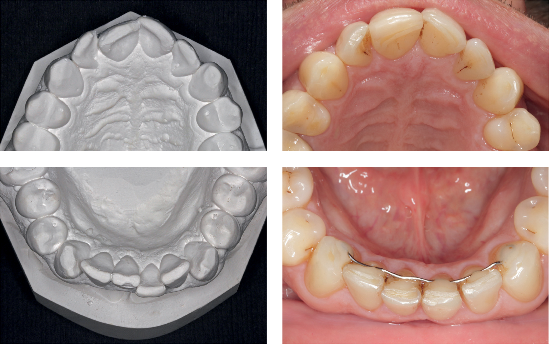 Tandstand van hoornist voor en na orthodontische behandeling