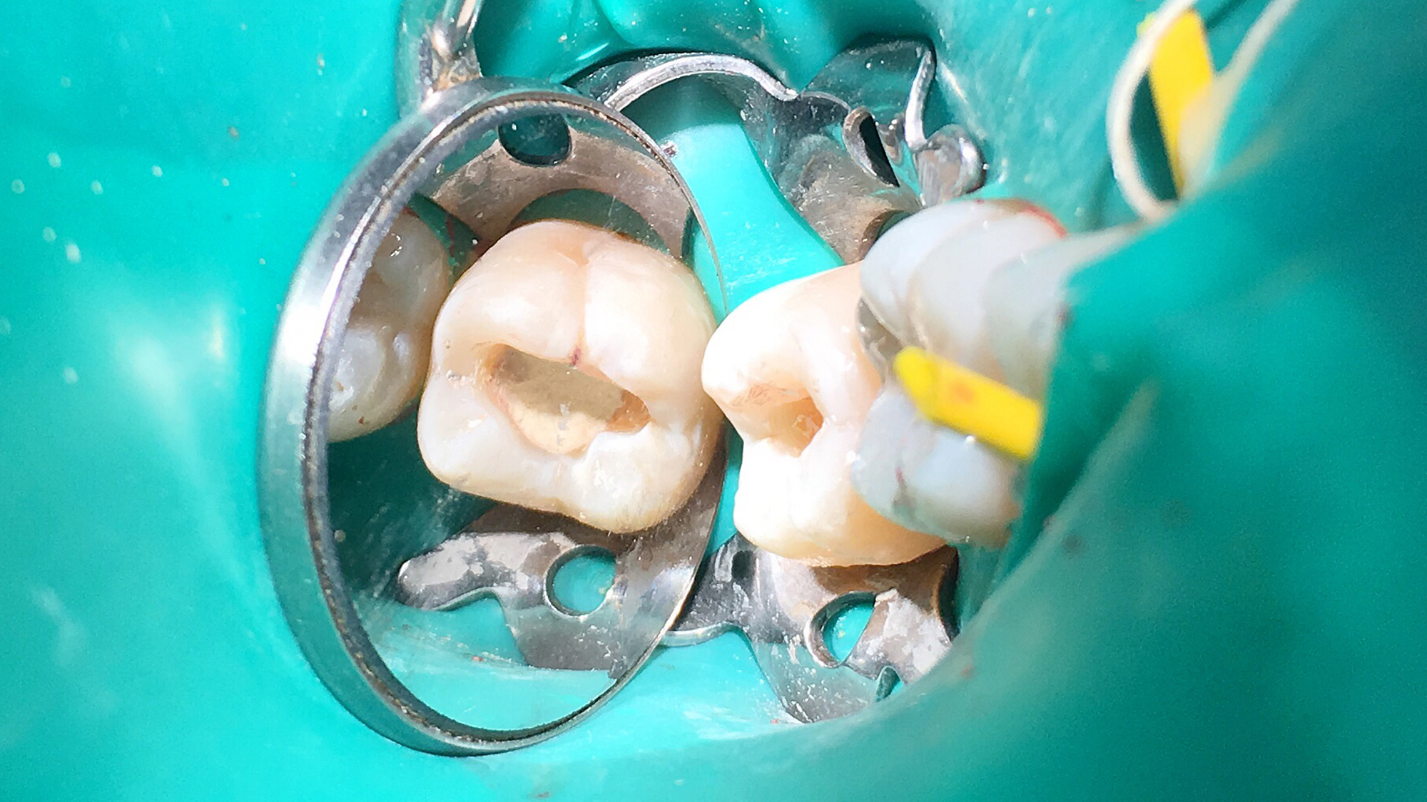 Partiële pulpotomie bij permanente molaren