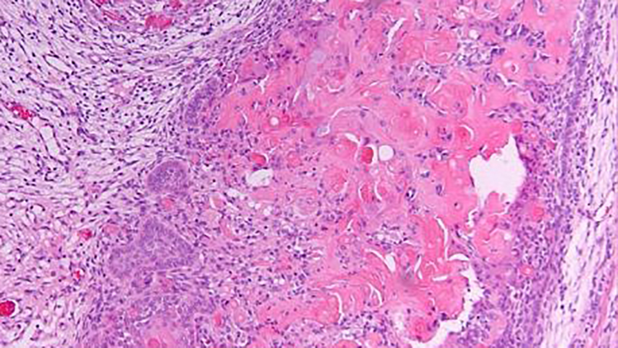 Dentinogene ghost cell-tumor in de onderkaak