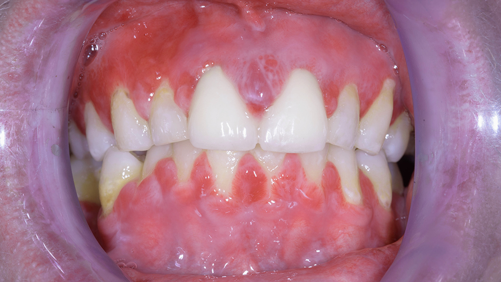 Orale graft-versus-hostziekte: implicaties voor mondzorgverleners