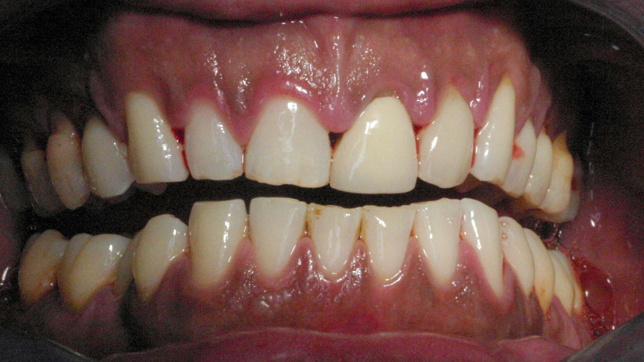 Serie: Medicamenten en mondzorg. Hyperpigmentatie van de orale slijmvliezen door afamelanotide